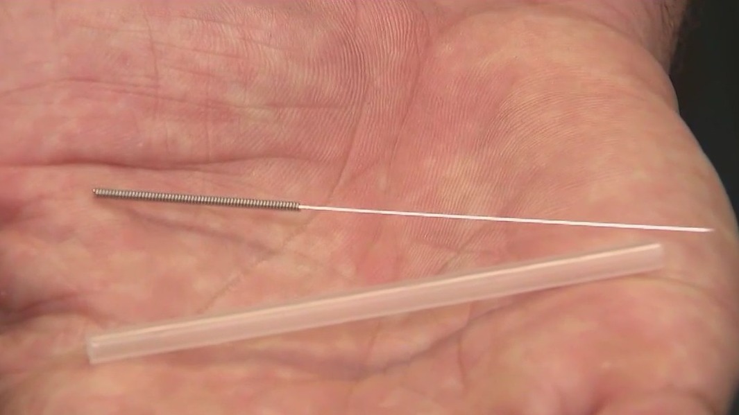 'Dry needling' therapy growing in popularity for pain management